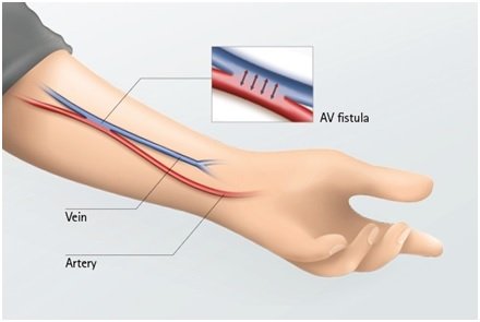 Arteriovenous Fistula treatment in kukaptally hyderabad