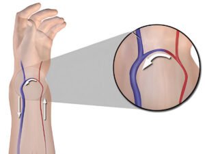 Av Fistula Surgery cost in Hyderabad