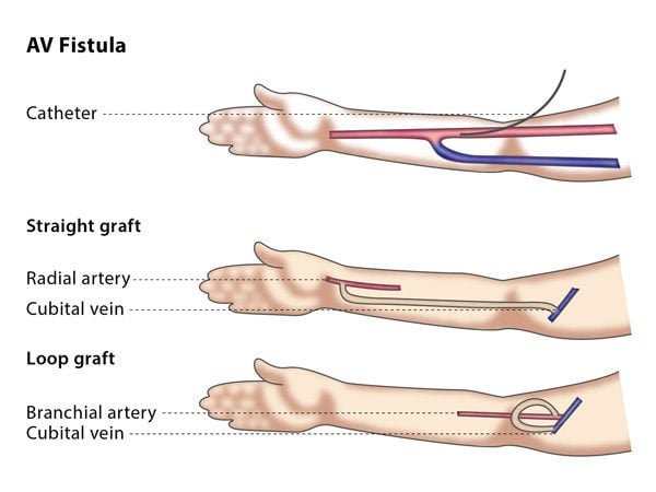 Av Fistula Surgery cost in Hyderabad