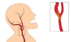 https://padmajacosmetics.com/carotid-artery-diseases-stroke-cost-hyderabad