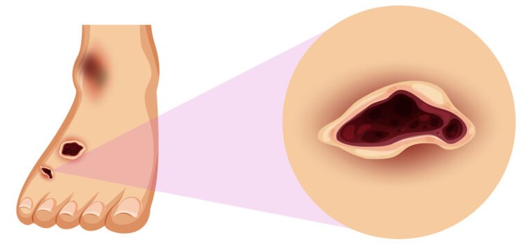 Diabetic Foot Ulcer surgery cost in Hyderabad