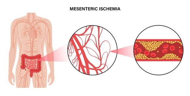 Mesenteric Artery Disease surgery cost hyderabad