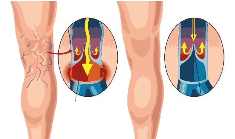 Varicose veins treatment cost in Hyderabad​