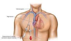 Vascular Access for Hemodialysis surgery cost Hyderabad