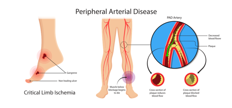 Peripheral arterial disease surgery cost Hyderabad