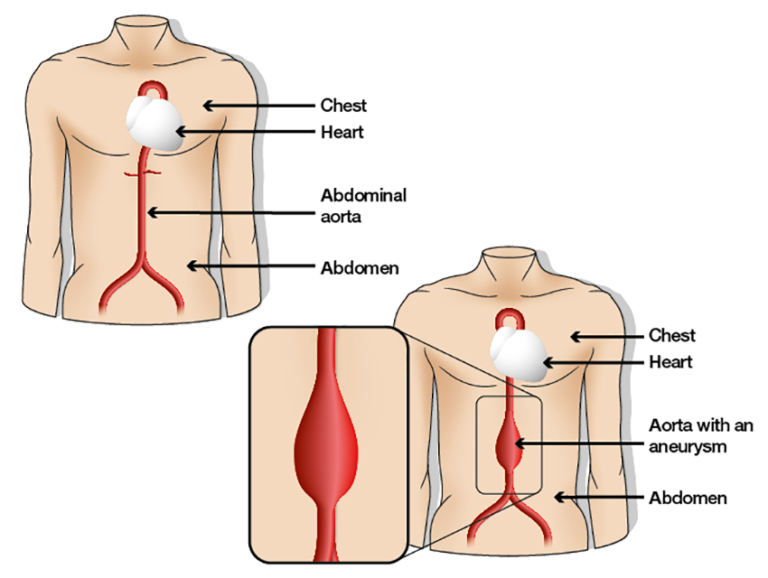 Abdominal Aortic Aneurysm surgery cost hyderabad