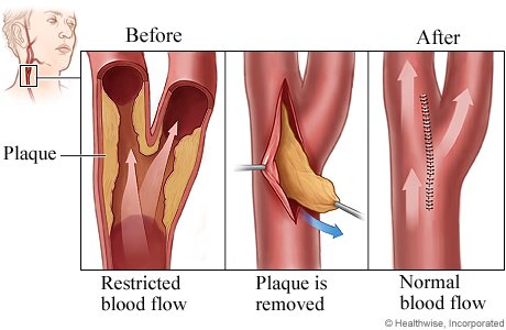 Carotid Artery Diseases surgery cost hyderabad
