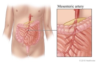 Mesenteric Artery Disease surgery cost hyderabad