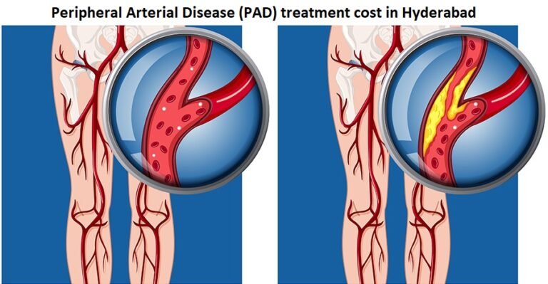 Peripheral arterial disease surgery cost Hyderabad