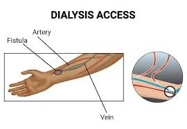 Vascular Access for Hemodialysis treatment in hyderabad